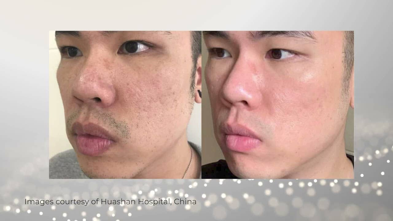 neogen plasma how does it work